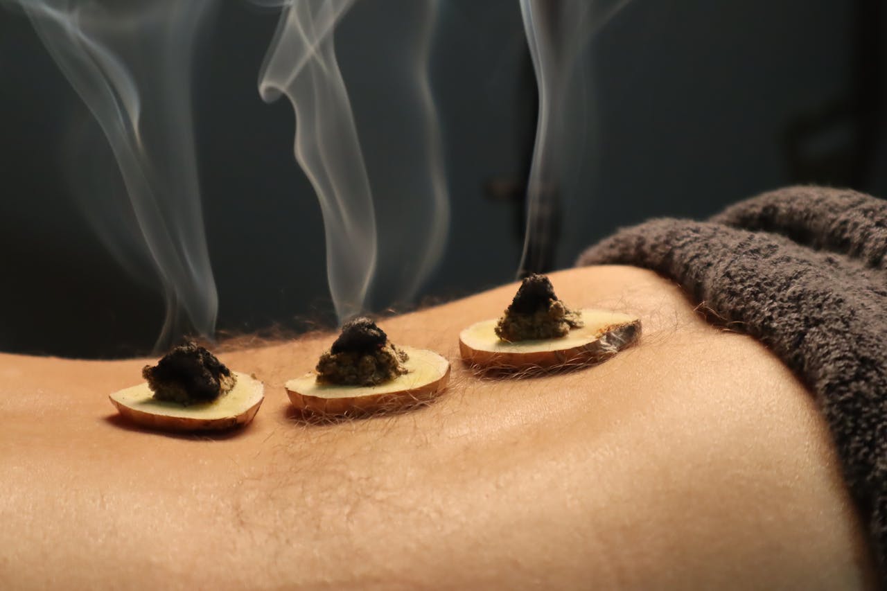 Close-up of traditional moxibustion therapy with smoke rising from moxa cones.